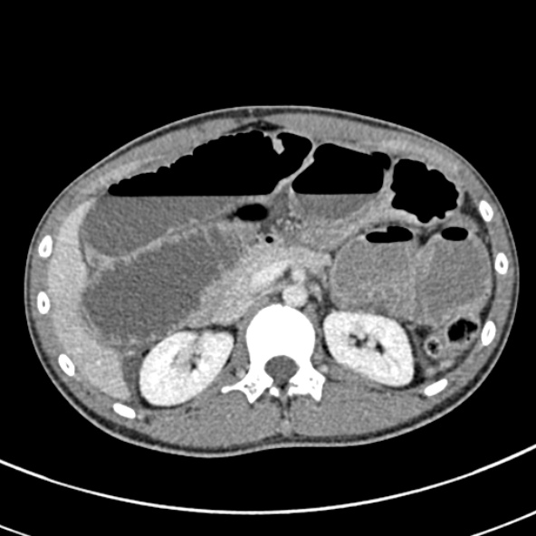 Adhesional small bowel obstruction (Radiopaedia 52107-57980 Axial C+ portal venous phase 37).jpg