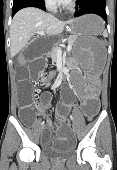 Adhesional small bowel obstruction (Radiopaedia 52107-57980 Coronal C+ portal venous phase 38).jpg