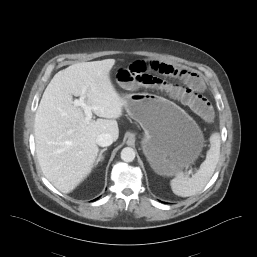 File:Adhesions within abdominal wall hernia (Radiopaedia 58283-65394 Axial C+ portal venous phase 20).png