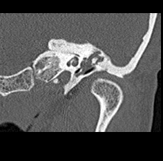 File:Adhesive chronic otitis media (Radiopaedia 14270-14148 Coronal bone window - left 10).jpg