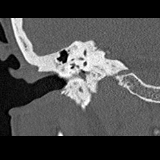 File:Adhesive chronic otitis media (Radiopaedia 14270-14148 Coronal bone window - right 14).jpg