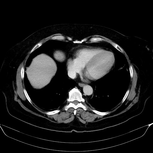 Adrenal cortical carcinoma (Radiopaedia 64017-72769 Axial C+ portal venous phase 3).jpg