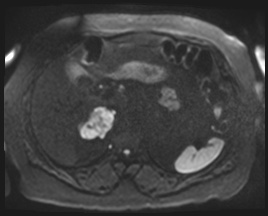 Adrenal cortical carcinoma (Radiopaedia 64017-72770 Axial DWI 98).jpg