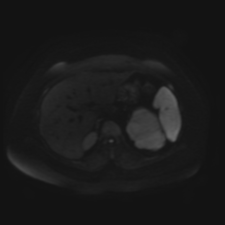 Adrenal cortical carcinoma (Radiopaedia 70906-81116 Axial DWI 37).jpg