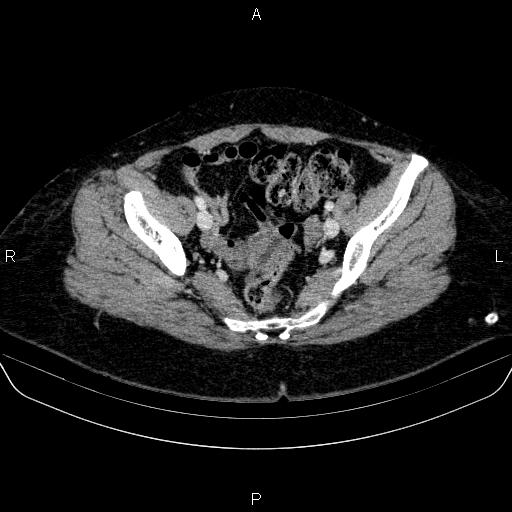 Adrenal cortical carcinoma (Radiopaedia 84882-100379 Axial C+ portal venous phase 81).jpg