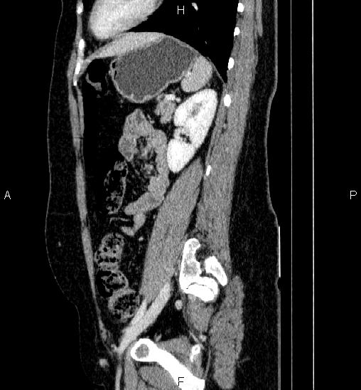 Adrenal cortical carcinoma (Radiopaedia 84882-100379 Sagittal C+ portal venous phase 61).jpg
