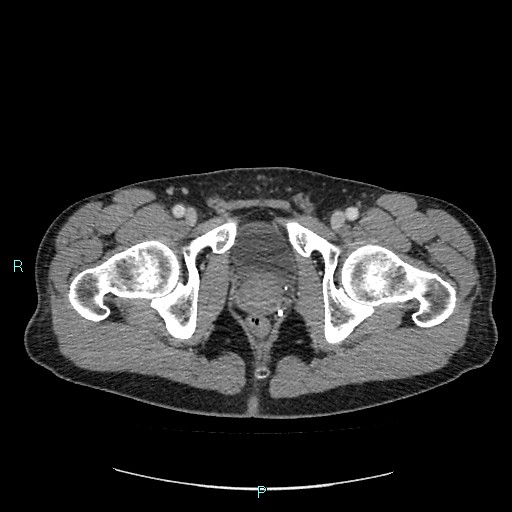 File:Adrenal cystic lymphangioma (Radiopaedia 83161-97534 Axial C+ portal venous phase 98).jpg
