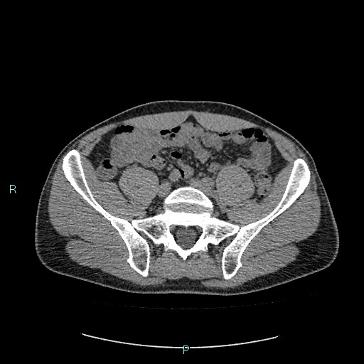 Adrenal cystic lymphangioma (Radiopaedia 83161-97534 Axial non-contrast 70).jpg