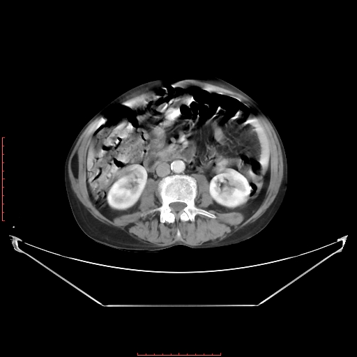 File:Adrenal hemangioma (Radiopaedia 68923-78668 Axial C+ portal venous phase 38).jpg