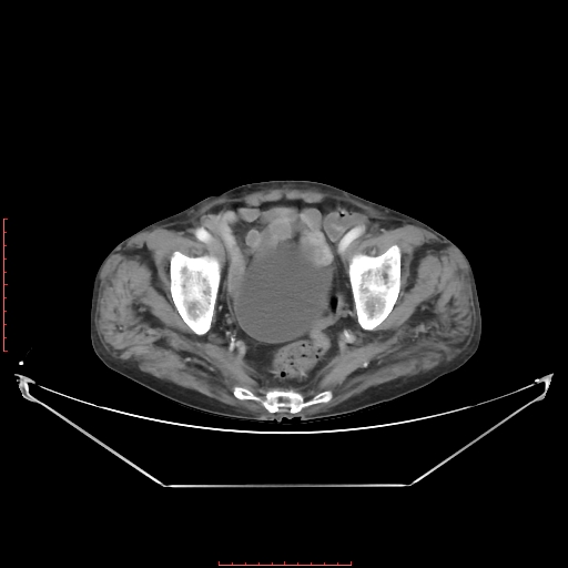 Adrenal hemangioma (Radiopaedia 68923-78668 Axial C+ portal venous phase 62).jpg