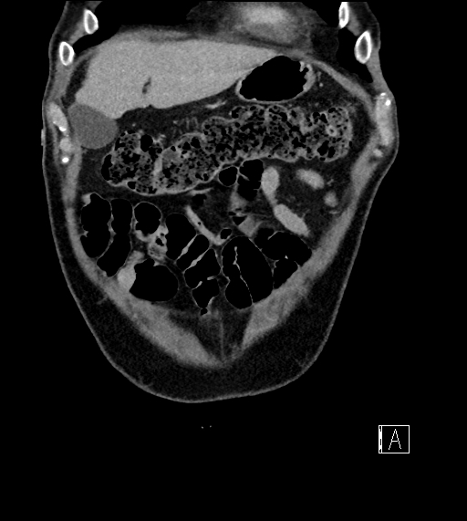 Adrenal lymphoma (Radiopaedia 73730-84529 Coronal C+ portal venous phase 13).jpg