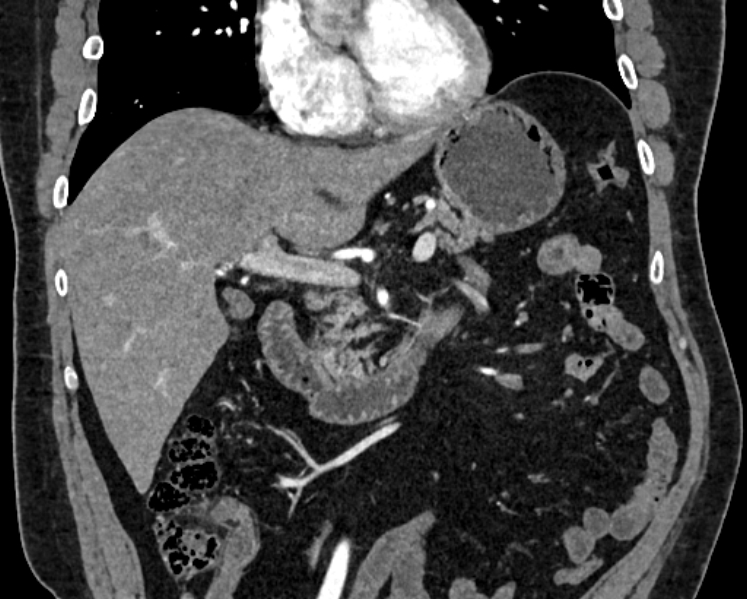 File:Adrenal metastases (Radiopaedia 73082-83791 Coronal C+ arterial phase 8).jpg