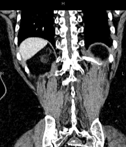 File:Adrenal myelolipoma (Radiopaedia 82742-96986 Coronal renal cortical phase 63).jpg