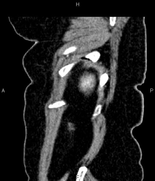 Adrenal myelolipoma (Radiopaedia 82742-96986 Sagittal renal cortical phase 98).jpg