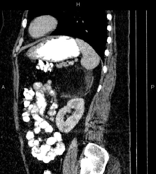 Adrenal myelolipoma (Radiopaedia 84319-99617 Sagittal renal cortical phase 70).jpg