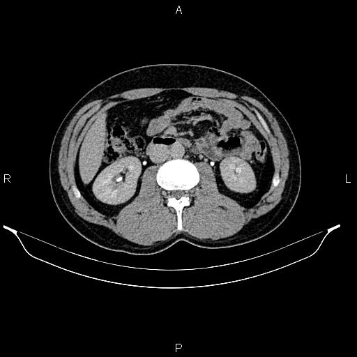 Adrenal myelolipoma (Radiopaedia 87794-104246 Axial renal excretory phase 47).jpg