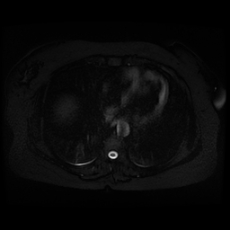 File:Adrenal myelolipoma - MRI (Radiopaedia 83249-97646 Axial STIR 2).jpg