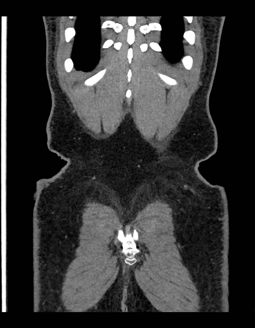 Adrenal myelolipoma - bilateral (Radiopaedia 74805-85810 Coronal C+ portal venous phase 55).jpg
