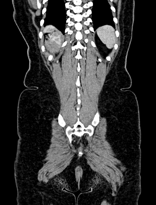 Adrenocortical carcinoma (Radiopaedia 87281-103569 Coronal C+ portal venous phase 135).jpg