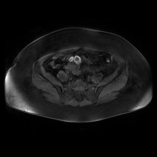 File:Adult granulosa cell tumor of the ovary (Radiopaedia 64991-73953 axial-T1 Fat sat post-contrast dynamic 11).jpg