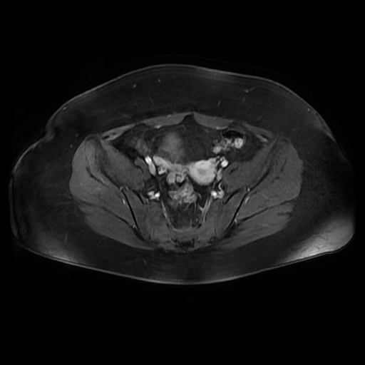 File:Adult granulosa cell tumor of the ovary (Radiopaedia 64991-73953 axial-T1 Fat sat post-contrast dynamic 44).jpg