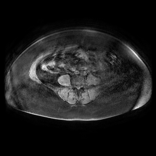 File:Adult granulosa cell tumor of the ovary (Radiopaedia 64991-73953 axial-T1 Fat sat post-contrast dynamic 9).jpg