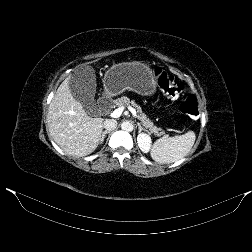 File:Afferent loop syndrome - secondary to incarcerated trocar site hernia (Radiopaedia 82959-97305 Axial C+ portal venous phase 73).jpg
