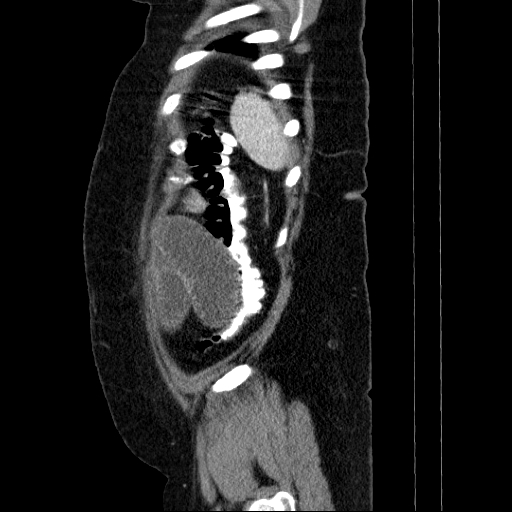 Afferent loop syndrome - secondary to incarcerated trocar site hernia (Radiopaedia 82959-97305 Sagittal C+ portal venous phase 17).jpg