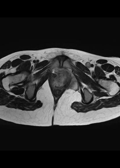 File:Aggressive angiomyxoma of the pelvis and perineum (Radiopaedia 59162-66479 Axial T2 3).jpg