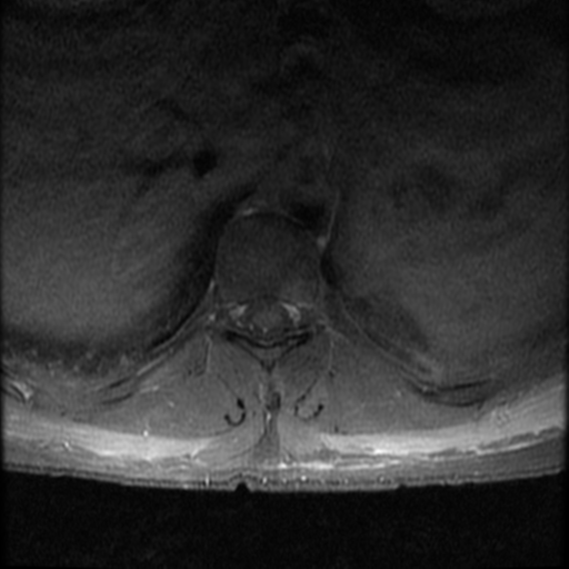 File:Aggressive vertebral hemangioma (Radiopaedia 39937-42404 Axial T1 C+ fat sat 11).png
