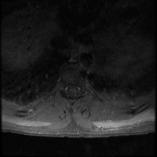 File:Aggressive vertebral hemangioma (Radiopaedia 39937-42404 Axial T1 C+ fat sat 14).png