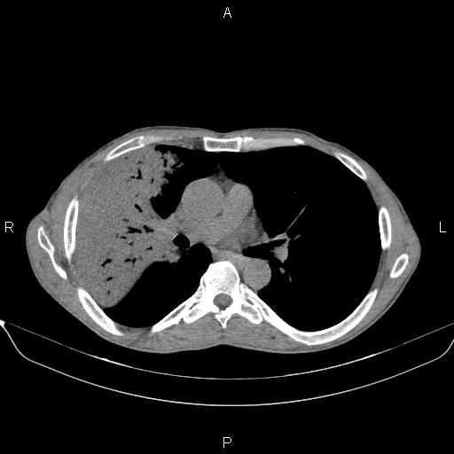Air bronchogram in pneumonia (Radiopaedia 85719-101512 Axial non-contrast 32).jpg