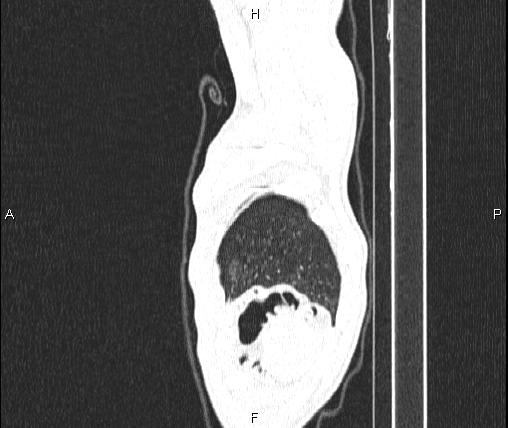 Air bronchogram in pneumonia (Radiopaedia 85719-101512 Sagittal lung window 98).jpg