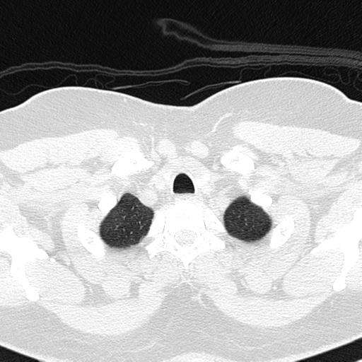 File:Air trapping in small airway disease (Radiopaedia 61685-69694 Axial lung window 12).jpg