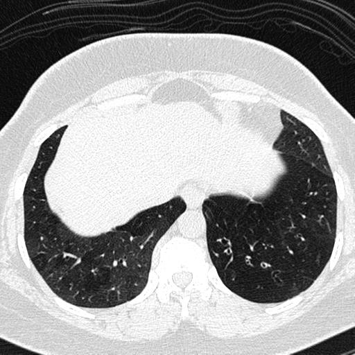 File:Air trapping in small airway disease (Radiopaedia 61685-69694 Axial lung window 153).jpg
