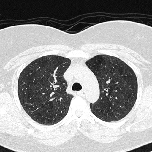 Air trapping in small airway disease (Radiopaedia 61685-69694 Axial lung window 49).jpg