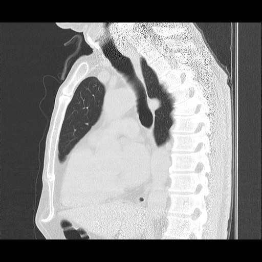 Allergic bronchopulmonary aspergillosis (ABPA) (Radiopaedia 60594-68313 Sagittal lung window 30).jpg