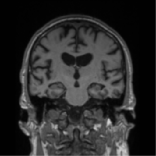 Alzheimer's disease- with Gerstmann syndrome and dressing apraxia (Radiopaedia 54882-61150 Coronal T1 44).png