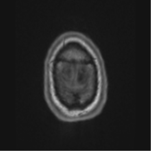 Alzheimer's disease- with apraxia (Radiopaedia 54763-61011 Axial T1 74).png