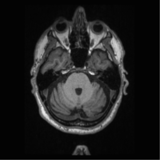 Alzheimer disease - probable (Radiopaedia 35334-36837 Axial T1 24).png