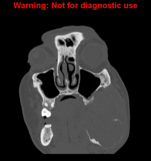 File:Ameloblastoma (Radiopaedia 13276-13280 Coronal non-contrast 6).jpg