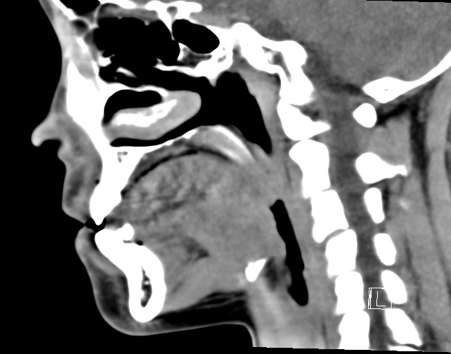 File:Ameloblastoma (Radiopaedia 26645-26793 Sagittal C+ delayed 17).jpg