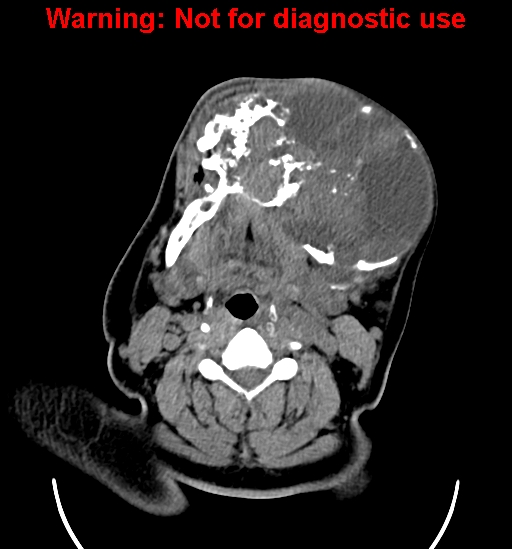 File:Ameloblastoma (Radiopaedia 33126-34164 A 14).jpg