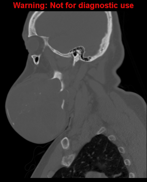 Ameloblastoma (Radiopaedia 33126-34164 Sagittal bone window 25).jpg