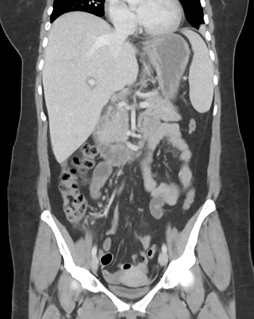 Amoebic liver abscess (Radiopaedia 52611-58530 B 30).png
