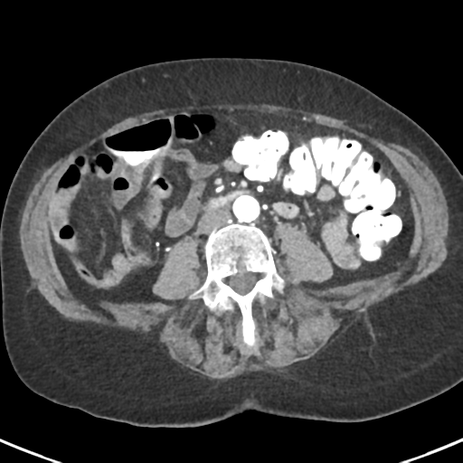 File:Ampullary adenocarcinoma (Radiopaedia 34013-35237 B 58).png