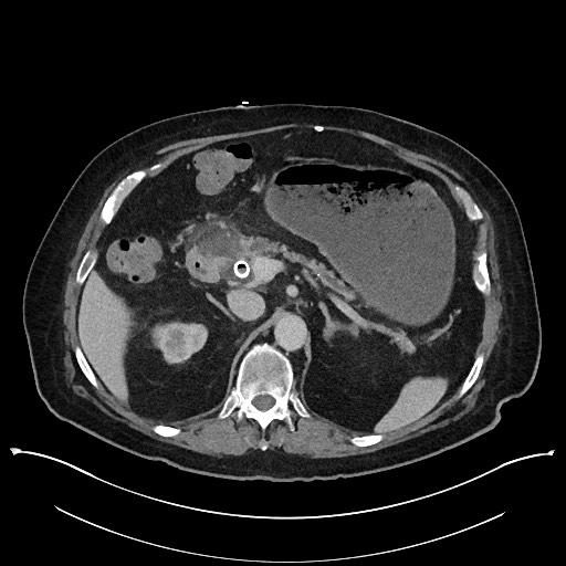 Ampullary adenocarcinoma (Radiopaedia 59373-66737 A 55).jpg