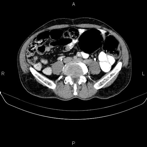 Ampullary adenocarcinoma (Radiopaedia 86093-102032 Axial C+ delayed 69).jpg