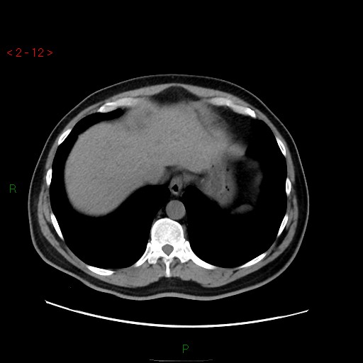 File:Ampullary carcinoma (Radiopaedia 56396-63056 Axial non-contrast 8).jpg