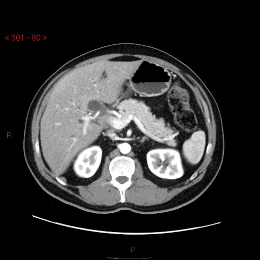 Ampullary carcinoma (Radiopaedia 56396-63056 B 26).jpg